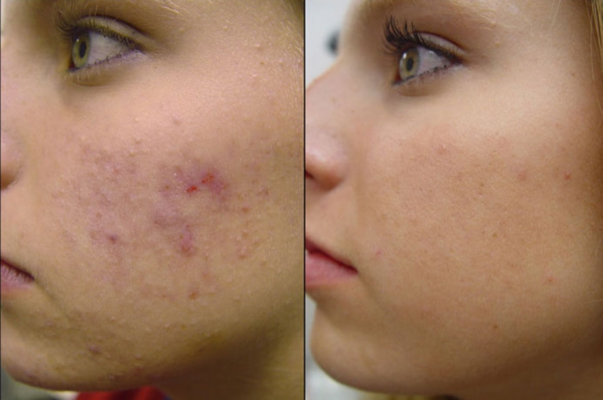 Before and after acne treatment — clear glowing skin results