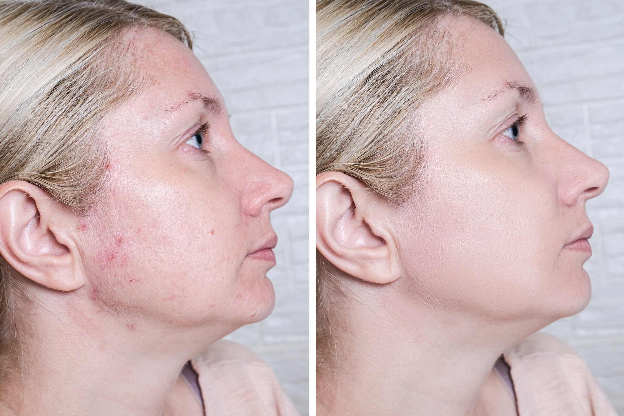 Before and after — right cheek skin texture and pore refinement