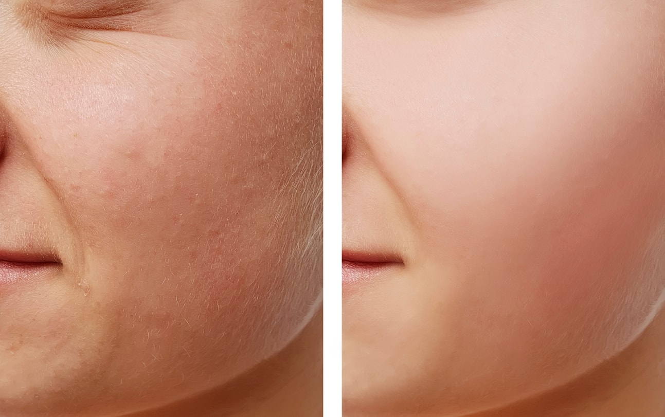 Before and after — cheek skin texture and pore refinement results