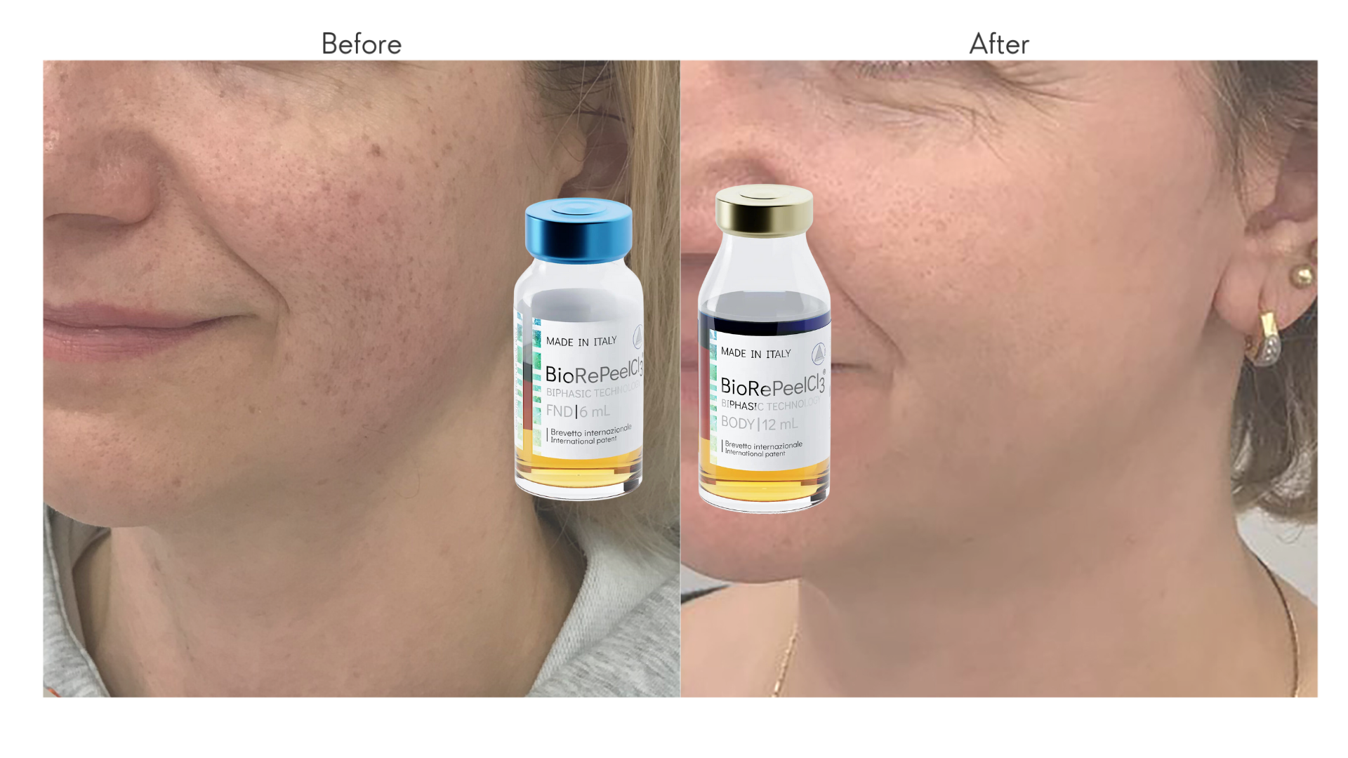 BioRePeelCl3 before and after — visibly clearer, smoother skin with reduced pigmentation