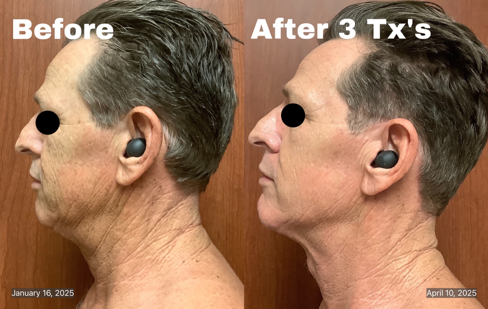 Before and after — face and neck skin resurfacing