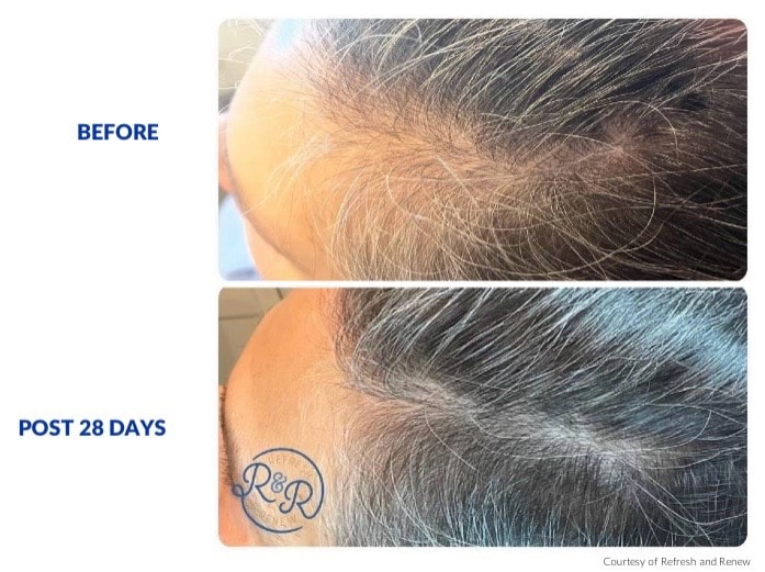 Hair regrowth before and after 28 days — courtesy of Refresh and Renew