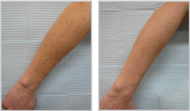 Before and after IPL treatment on arms — dramatic reduction in age spots and sun damage